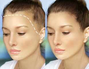 Alopecia Areata,female pattern baldness,Treatment for hair loss,Hair transplant,Surgery to implant...