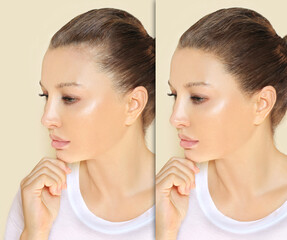 Alopecia Areata,female pattern baldness,Treatment for hair loss,Hair transplant,Surgery to implant artificial hairs