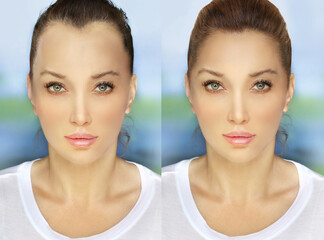 Alopecia Areata,female pattern baldness,Treatment for hair loss,Hair transplant,Surgery to implant...