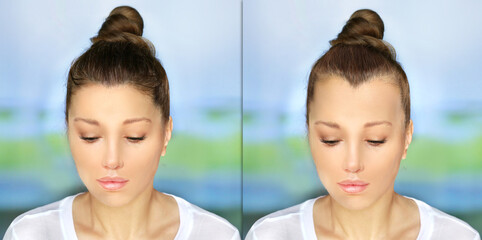 Alopecia Areata,female pattern baldness,Treatment for hair loss,Hair transplant,Surgery to implant...