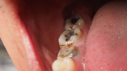 Decayed tooth root canal treatment. Tooth or teeth decay of lower molar. Restoration with a...