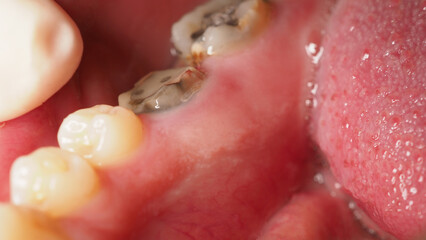Decayed tooth root canal treatment. Tooth or teeth decay of lower molar. Restoration with a...