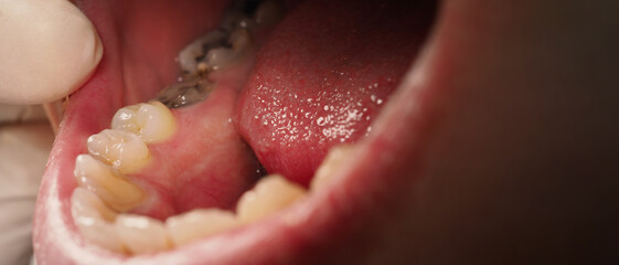 Decayed tooth root canal treatment. Tooth or teeth decay of lower molar. Restoration with a...