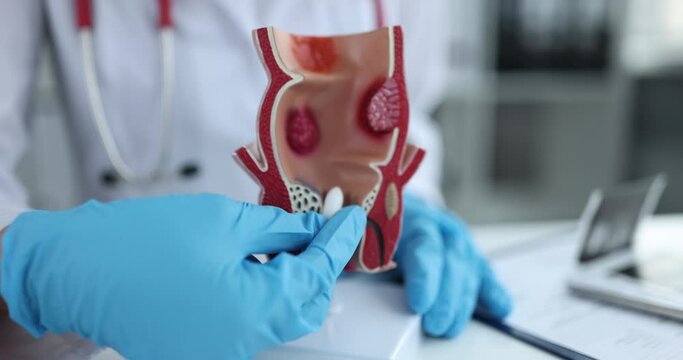 Doctor holds medical medicine suppository and anal sphincter