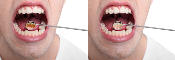 Collage with photos of man before and after professional treatment of dental plaque on white...