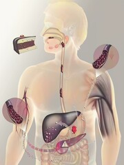 Secretion of insulin on a person with diabetes type 2. - obrazy, fototapety, plakaty