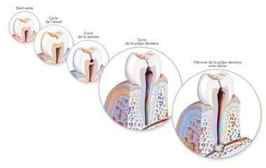 Tooth: formation and development of dental caries.