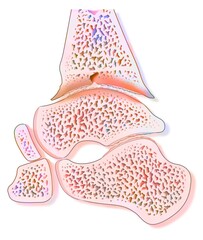 Hemophilic arthropathy of the ankle (hemarthrosis).