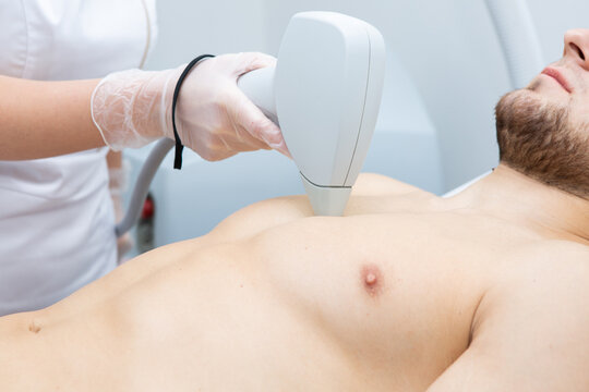 Laser hair removal for men's chest