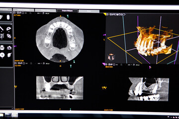 Jaw scanner prescribed for dental implant placement. © RFBSIP