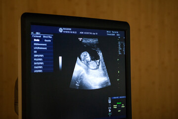Fetal ultrasound of the 1st trimester of the fetus.