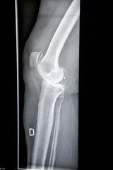 X-ray of the knee of a patient with the onset of osteoarthritis.