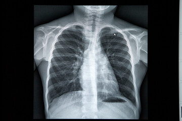 Normal chest x-ray in a child in a radiology center.