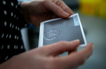 Lesbian woman looking at photograph of fertilized egg selected for IVF.