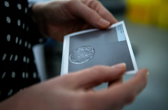 Lesbian woman looking at photograph of fertilized egg selected for IVF.