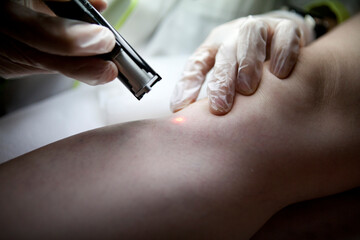 Laser removal of spider veins from the legs in a beauty salon.