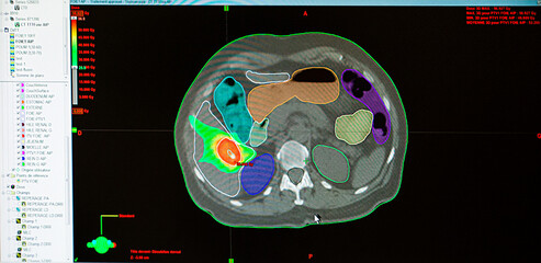 Treatment of a liver tumor with radiotherapy.