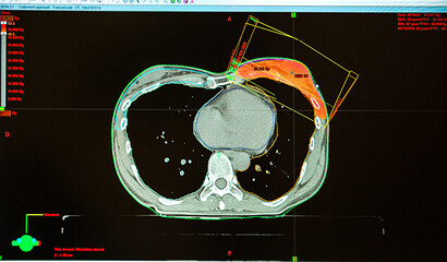 Treatment of cancer in the left breast by radiotherapy.