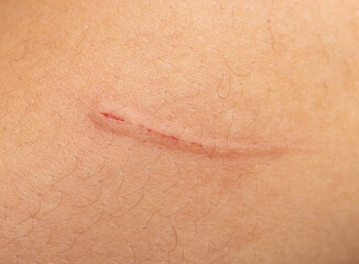 scratch from a cat's claw on the skin