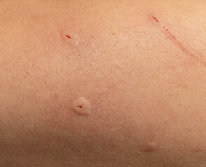 Fototapeta premium scratch from a cat's claw on the skin