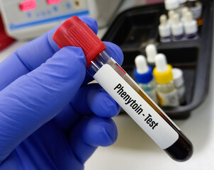 Blood sample for Phenytoin test, therapeutic drug, to maintain a therapeutic level and diagnose...