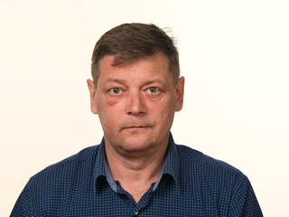 Obraz premium close-up portrait of a 50-year-old man with a swollen cheek and a black eye