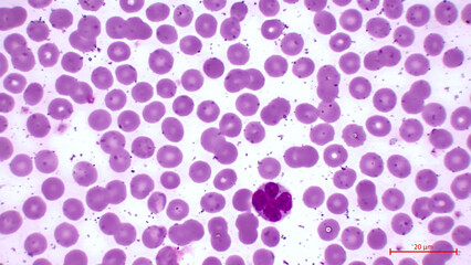 Blood smear. Light micrograph showing human blood cells. Erythrocytes are pink. They make up the majority of blood cells.  Also in the center you can see a large cell with a nucleus (neutrophil). 