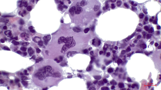 Light micrograph of a section through red bone marrow tissue. It consists mainly of haematopoietic tissue, where blood cells are created. In the center are three megakaryocytes.