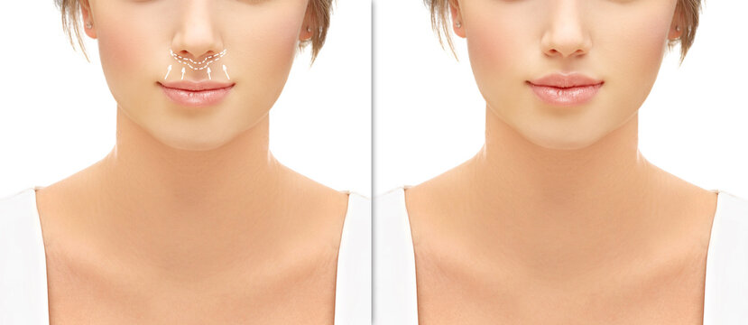 lip lift surgery,bullhorn technique, plastic surgery concept.