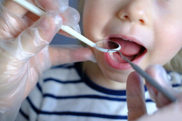 dentist, doctor examines oral cavity of small patient, uses mouth mirror, closeup baby teeth child,...