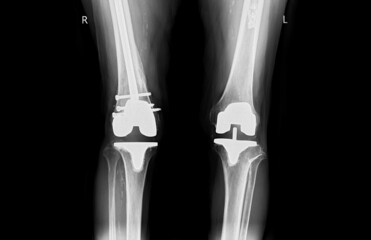 film x-ray  knee AP  view of osteoarthritis knee patient and artificial joint with Knee Replacement.