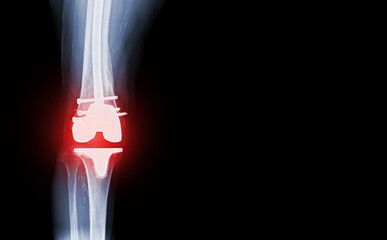 film x-ray  knee AP  view of osteoarthritis knee patient and artificial joint with Knee Replacement.