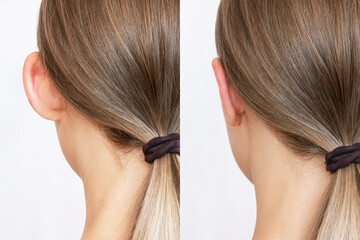 Cropped shot of woman's head with ears before and after otoplasty isolated on a white background....