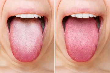 Fotobehang Female tongue with a white plaque. Comparison of a diseased tongue with a white plaque and a healthy clean tongue before and after treatment. The result of cleaning the tongue © Марина Демешко