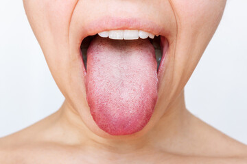Female tongue with a white plaque. Cropped shot of a young woman showing tongue isolated on a white...