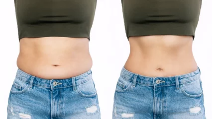 Poster Two shots of a woman's belly with excess fat and toned slim stomach  before and after losing weight isolated on a white background. Result of diet, liposuction, training. Healthy lifestyle © Марина Демешко