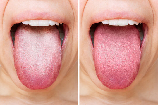 Tongue Scraping Images – Browse 5,428 Stock Photos, Vectors, and Video |  Adobe Stock
