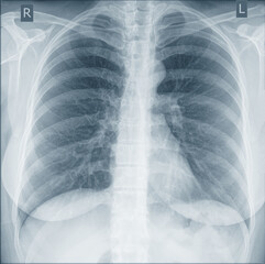 X-ray image of humen chest, for medical diagnosis