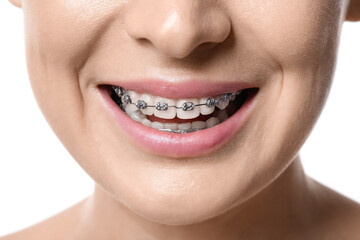 Woman with dental braces on white background, closeup