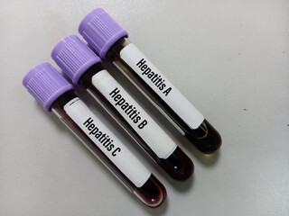 Blood samples tube with sample for hepatitis virus test (Hepatitis A, Hepatitis B, Hepatitis C),...