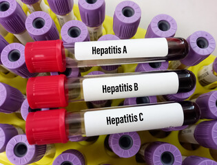 Blood samples tube with sample for hepatitis virus test (Hepatitis A, Hepatitis B, Hepatitis C),...