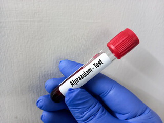 Blood sample for Alprazolam test, a drug used to treat anxiety and panic disorders.