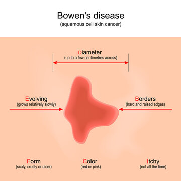 Bowen's disease. squamous cell skin cancer.