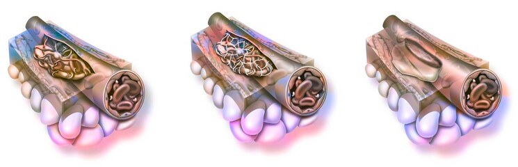 Healing: constitution of a plug consolidation of the platelet nail.