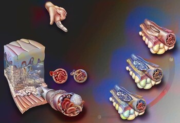 Healing: constitution of a plug consolidation of the platelet nail.