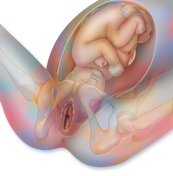Childbirth stage 1: the baby is engaged in the pelvis.