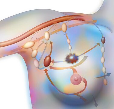 Axillary And Thoracic Lymph Node Chain In Breast Cancer.