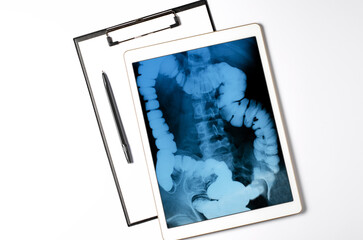X-ray image of the intestine in the tablet. The concept of telemedicine and diagnosis of diseases