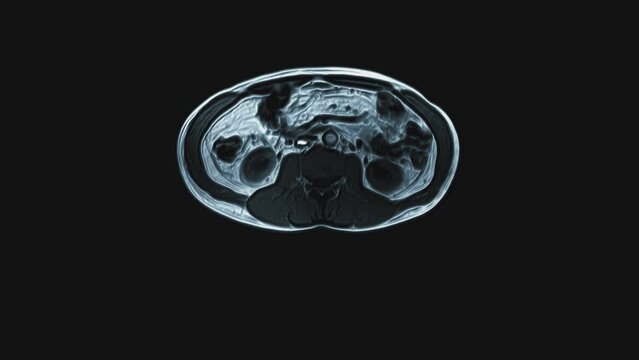Voluminous color CT scan of the abdomen. Computed tomography of the gastrointestinal tract, liver and kidneys