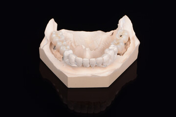 Plaster lower jaw model with zirconia teeth on implants. Process of manufacturing ceramic teeth on implants.